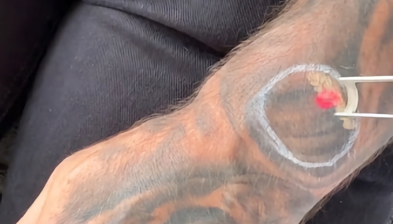 Tattooed Apple Watch User Turns to Laser Removal to Fix Pulse Detection Issues